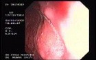 Zollinger- Ellison Syndrome - Gastric Ulcer with Gastrocolic Fistula (14 of 21)