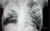 Tuberculosis