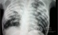 Tuberculosis