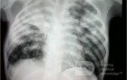 Tuberculosis