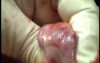Adenocarcinoma Of The Transverse Colon - Endoscopy (3 of 9)