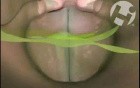 Laryngospasm