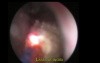 Uretero-nephrolithotripsy - Part 1