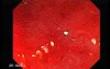 Colonoscopic Polypectomy (1 of 23)