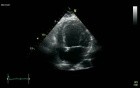 Dilated Cardiomyopathy - DCM