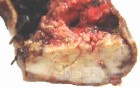 Gallbladder Adenocarcinoma and litiasis (5 of 13)