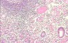 Adenocarcinoma of the cardias and gastric fundus with signet-ring cells (18 of 25)