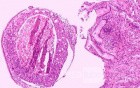 Ovarian Carcinoma Metastatic to Stomach and Duodenum (17 of 20)