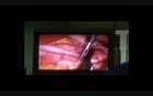 Laparoscopic Vertical Sleeve Gastrectomy