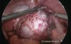 Large Ovarian Cyst - Laparoscopic Surgery