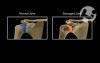 Chondrolysis of the Shoulder Joint