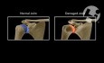 Chondrolysis of the Shoulder Joint
