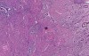 Adenomyosis