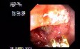 Rectal Adenocarcinoma - 77 Year - Old Woman