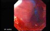 Esophageal Achalasia - Pneumatic Balloon Dilation, Video nr 2