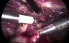 Laparoscopic Surgery of Right Ovarian Cyst - Salpingoophorectomy