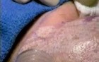 Wrinkle Removal - Laser Method