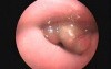 Epiglottitis In Scopy (OPD)