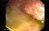 Severe case of Ischemic Colitis (6 of 19)