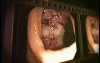 Colonoscopies of colon cancer