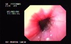 Treatment for Achalasia - Endoscopic Maneuvering to Overcome the Sphincter's Tension