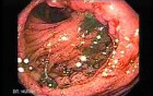 Stomach Cancer (2 of 2)
