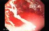 Barrett Adenocarcinoma - Therapeutic Endoscopy (4 of 7)