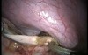 Transabdominal Transdiaphragmatic Excision of Pericardial Cyst - Laparoscopy