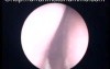 The View of Nasopharynx after Radiotherapy Treatment of Nasopharyngeal Carcinoma