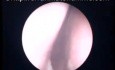 The View of Nasopharynx after Radiotherapy Treatment of Nasopharyngeal Carcinoma