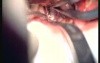 Brain tumor Removal