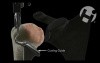 Shoulder Hemi-Arthroplasty