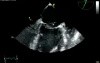 Severe Mitral Regurgitation - TOE - Rupture Chordae