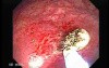 Rectal Stalked Polyp (7 of 7)