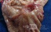 Diffuse Adenocarcinoma with signet ring cells (7 of 18)