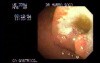 Doughnut - Shape Gastric Adenocarcinoma - Endoscopy
