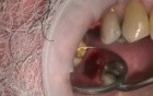 Immediate Implantation After Implant Microsurgery
