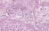 Acute Pancreatitis