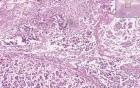 Acute Pancreatitis
