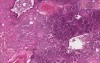 Bronchopneumonia with micro-abscesses - Histopathology - Lung