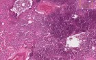 Bronchopneumonia with micro-abscesses - Histopathology - Lung