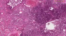 Bronchopneumonia with micro-abscesses - Histopathology - Lung