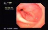 Gastric Adenocarcinoma - Obstruction 6