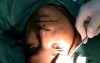 Scarless Brow lift