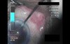 Cataract Surgery XII - Part 4