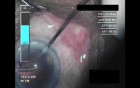 Cataract Surgery XII - Part 4
