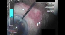 Cataract Surgery XII - Part 4