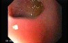 Choledocoduodenostomy and The Sump Syndrome (6 of 10)