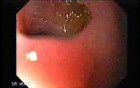 Choledocoduodenostomy and The Sump Syndrome (6 of 10)