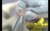 L4-5 Laser Discectomy